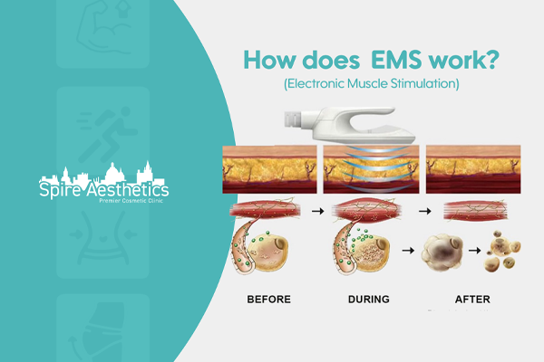 EMS treatment for post pregnancy weight loss treatment Bedford
