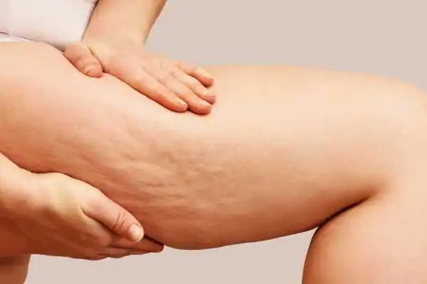 Image of woman showing leg with cellulite Bedford