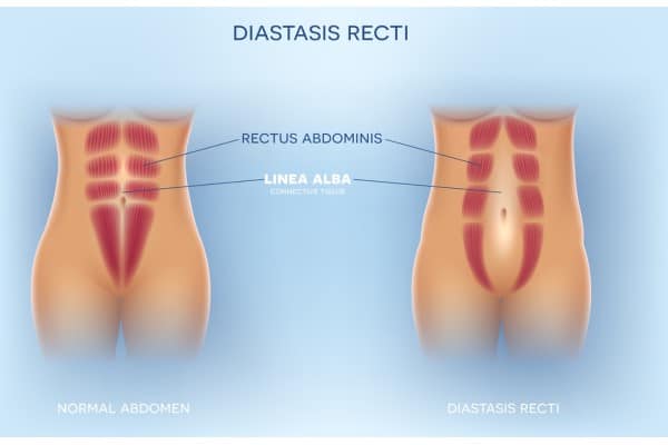 What Non-Surgical Options Are Available for Diastasis Recti Bedford?