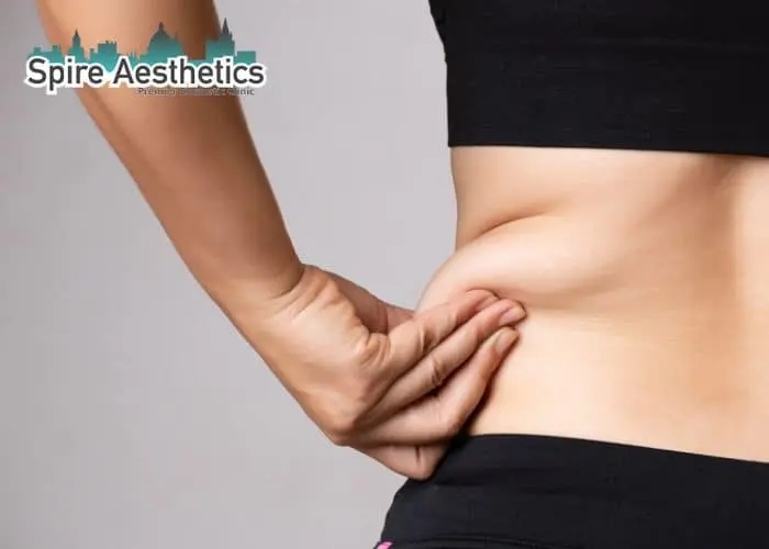 Image of woman pinching fat on their hips Bedford. Fat Freezing treatment