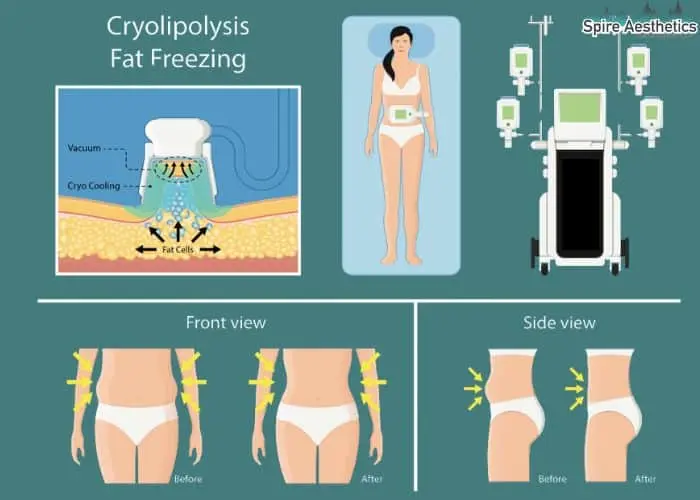 Fat freezing treatment Bedford benefits for competitions to remove stubborn fat deposits.