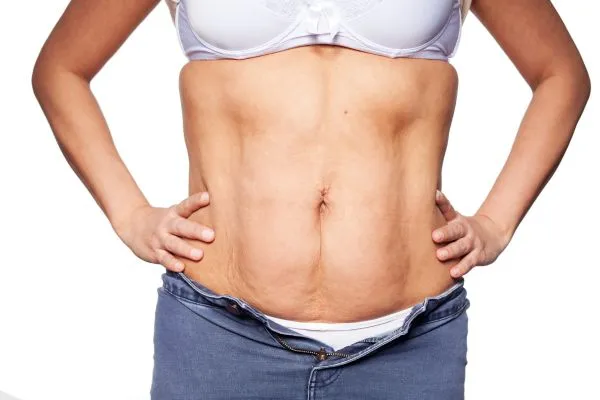 sagging skin on woman's stomach after weight loss injections Bedford
