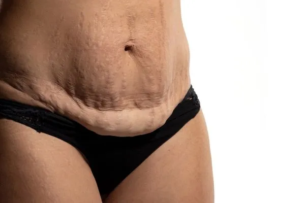 Image of womans stomach after weight loss injections Bedford showing saggy skin