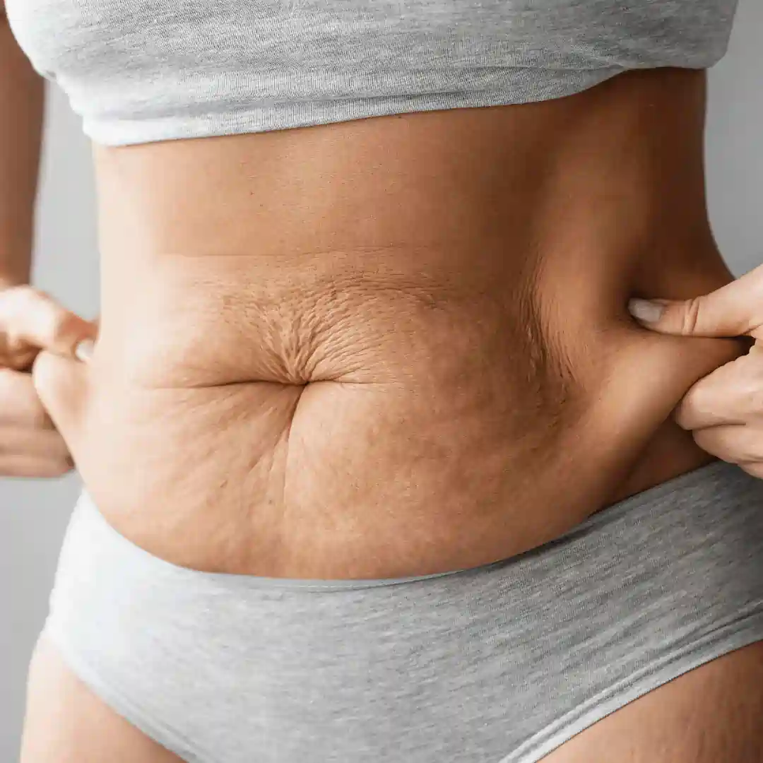 Is It Normal to Have Loose Skin After Pregnancy Bedford?