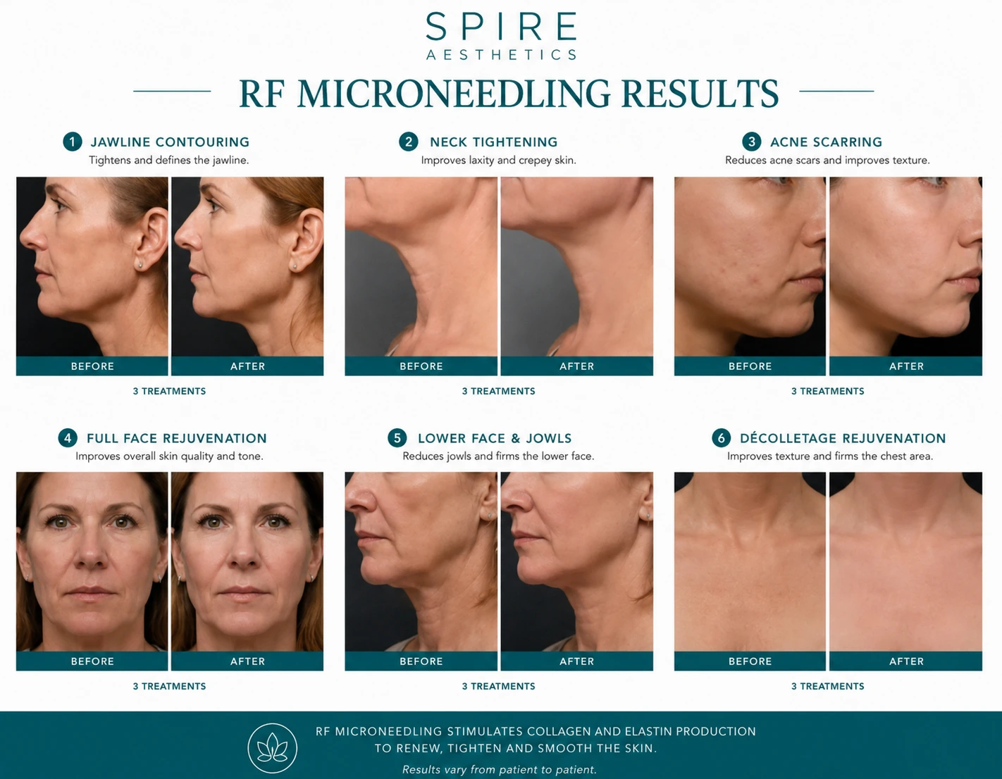 RF Microneedling Skin tightening Bedford results