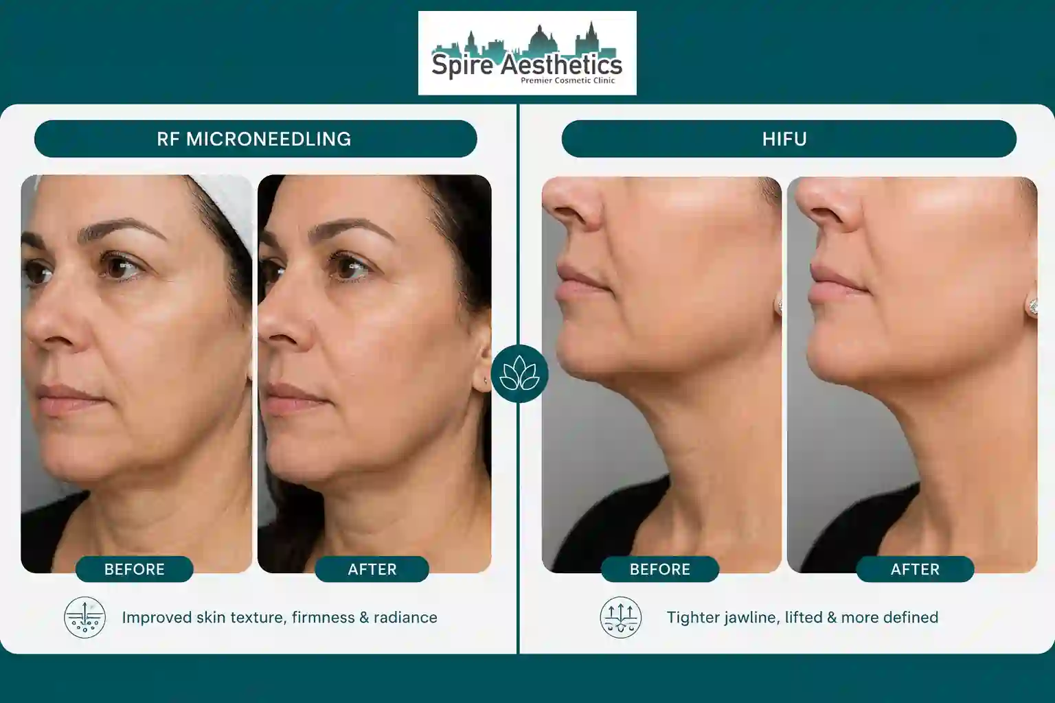 Can RF Microneedling and HIFU Be Combined Bedford?