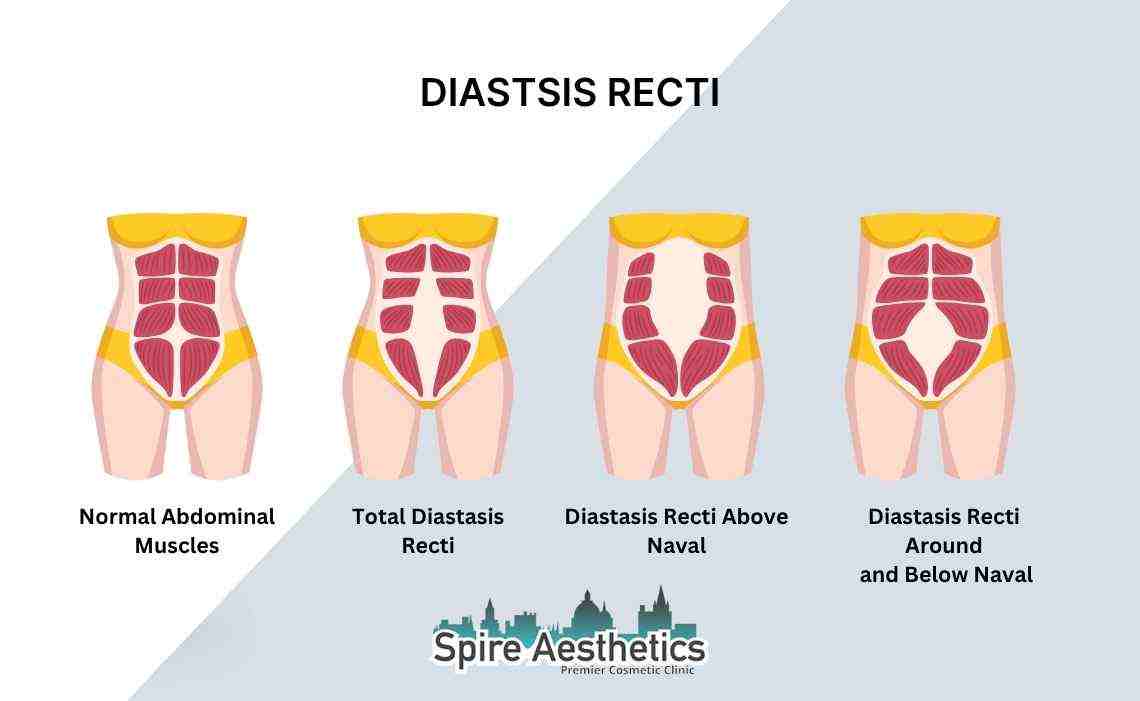 Is Non-Surgical Diastasis Recti Treatment Right for You? Common Concerns Answered Bedford